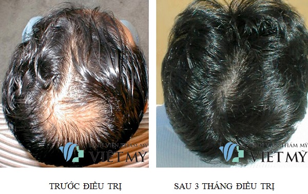 Top 7 địa chỉ chữa rụng tóc uy tín hiệu quả tại TPHCM