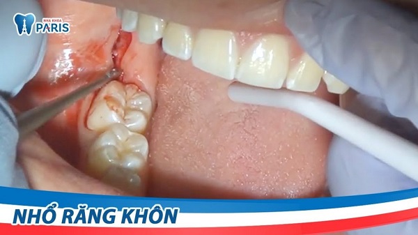 dia-chi-nho-rang-khon-tphcm-6