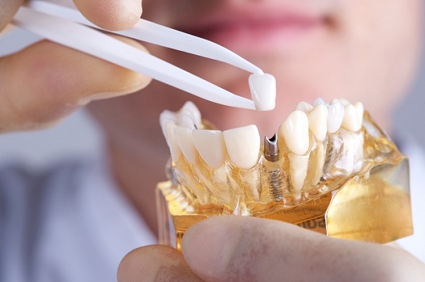 Top 10 địa chỉ trồng răng Implant uy tín nhất tại TP.HCM