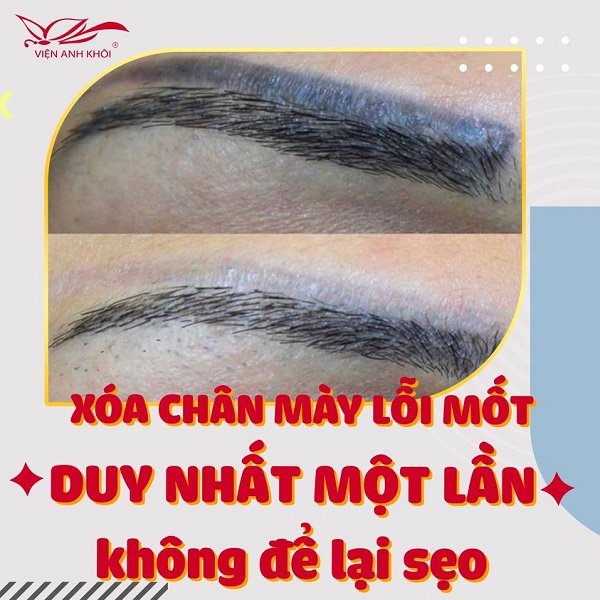 dia-chi-xoa-xam-long-may-tphcm-5